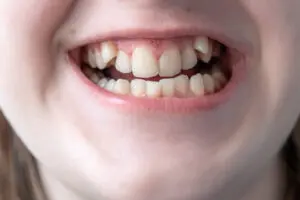 Dental Blog baby teeth baby teeth